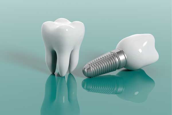 implantaten tandartspraktijk rivierenbuurt