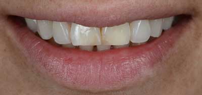Facing voor behandelingEsthetische Tandheelkunde tandartspraktijk Rivierenbuurt